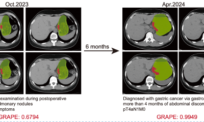 阿里达摩院AI多癌筛查又下一城，首次用平扫CT识别早期胃癌